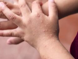 Waspada Flu Singapura, Balita Asal Seluma Dinyatakan Positif