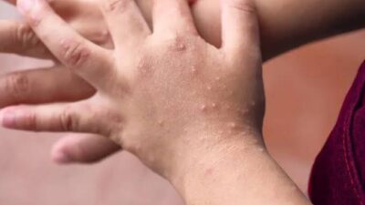 Waspada Flu Singapura, Balita Asal Seluma Dinyatakan Positif